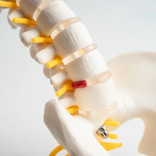 Spine model showing a herniated disc