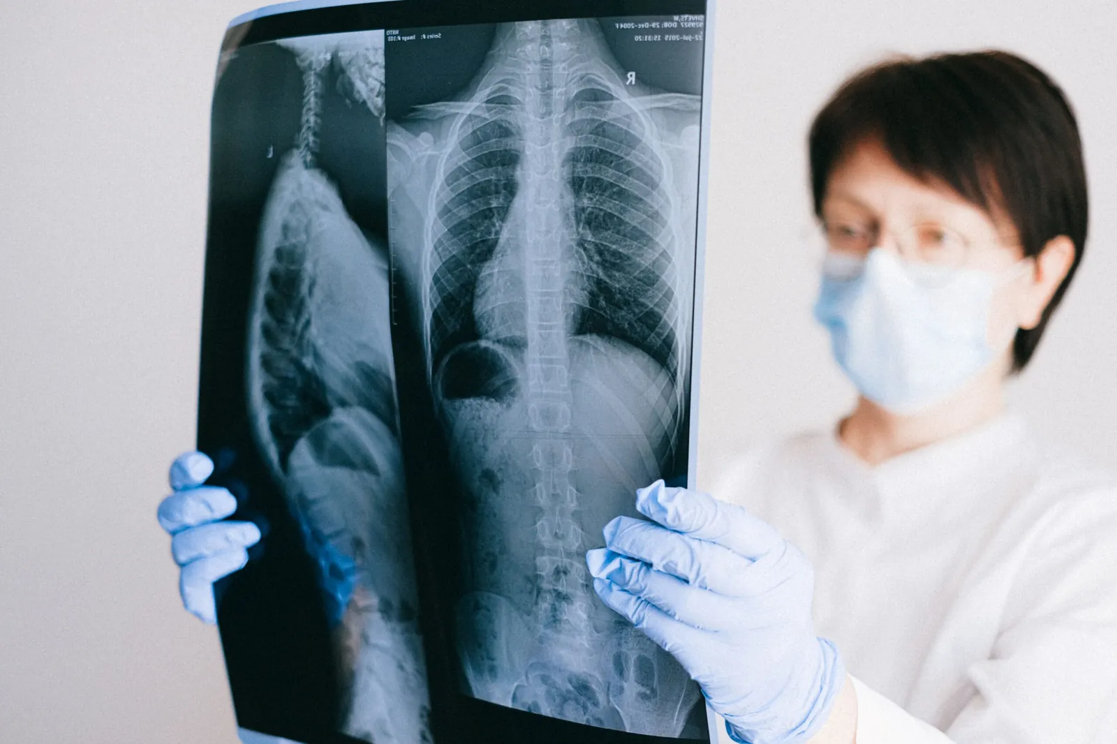 Doctor holding up a spine X-ray