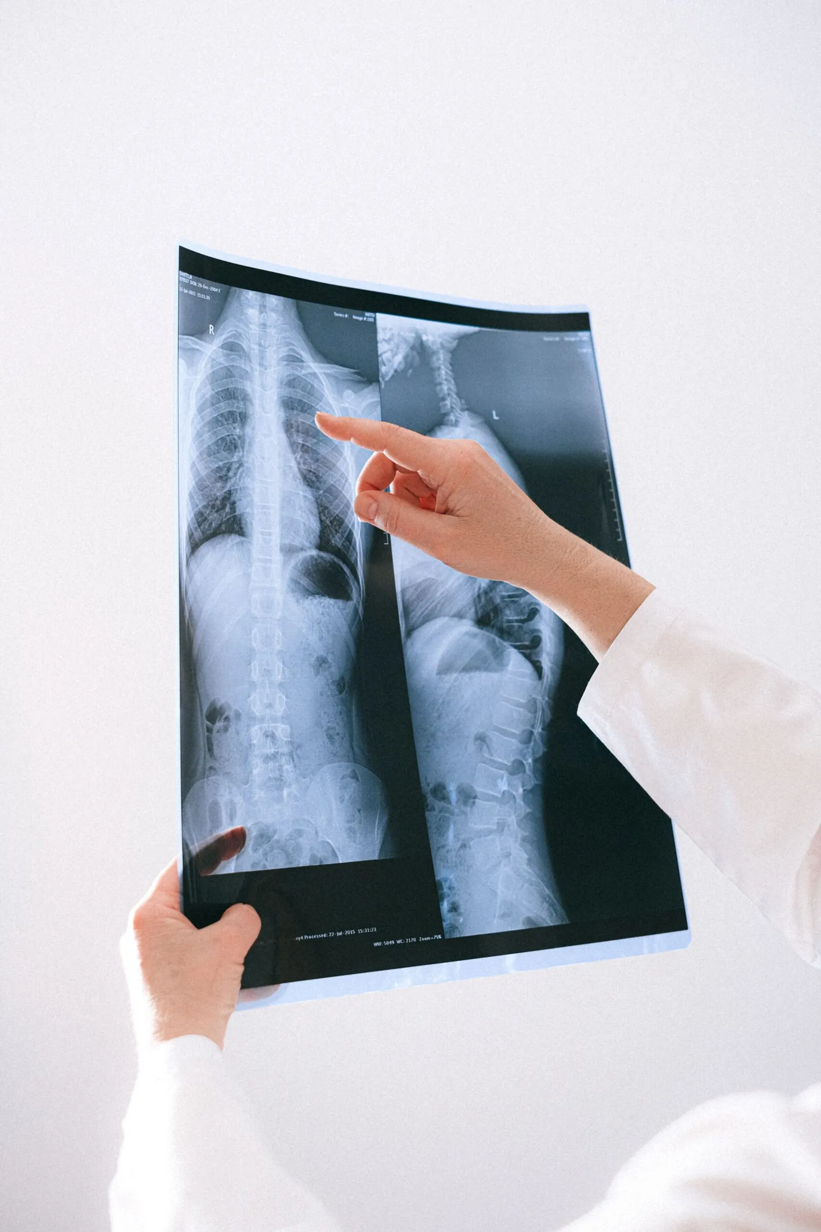 Doctor pointing to a spine X-ray
